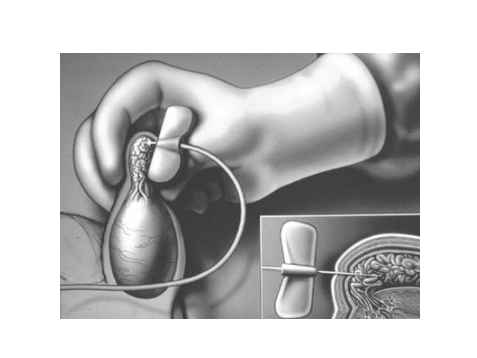 精索曲張睪丸下墜時