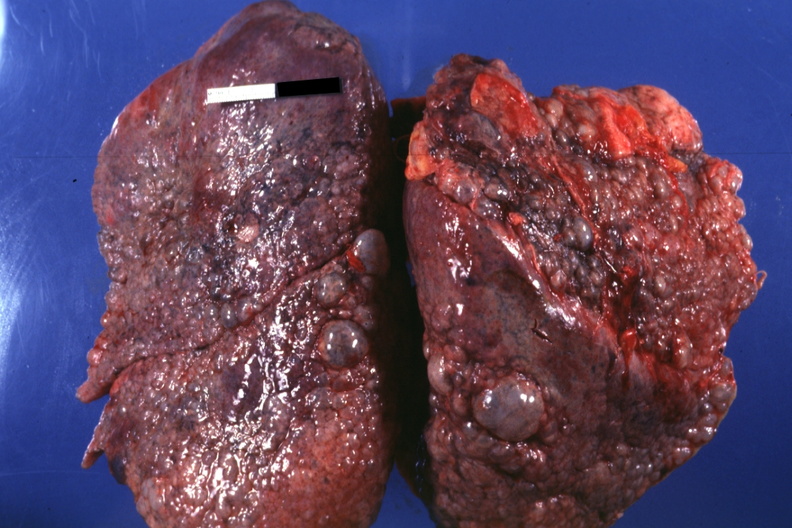 ＿雙肺肺纖維化肺灶