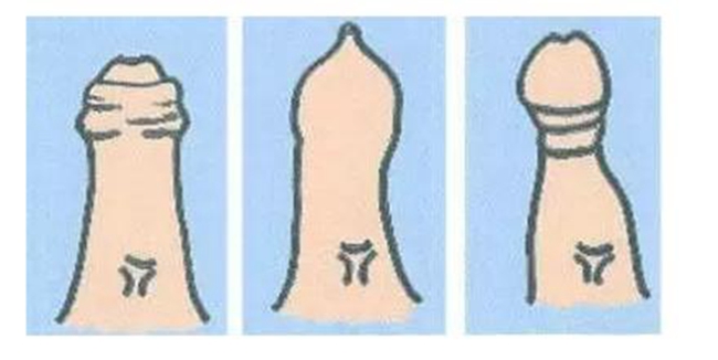 嵌頓包莖馬上得醫嗎 