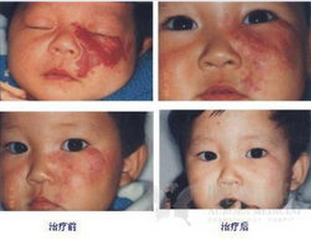 鮮紅斑痣激光治療恢復