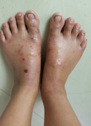 孕婦膽汁淤積症狀