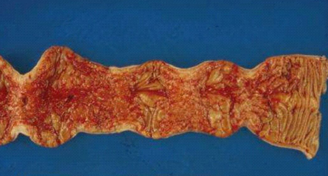 克羅恩病的小腸生理解剖