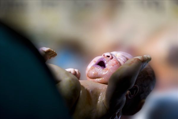 新生兒嘴唇發紫 (42) 