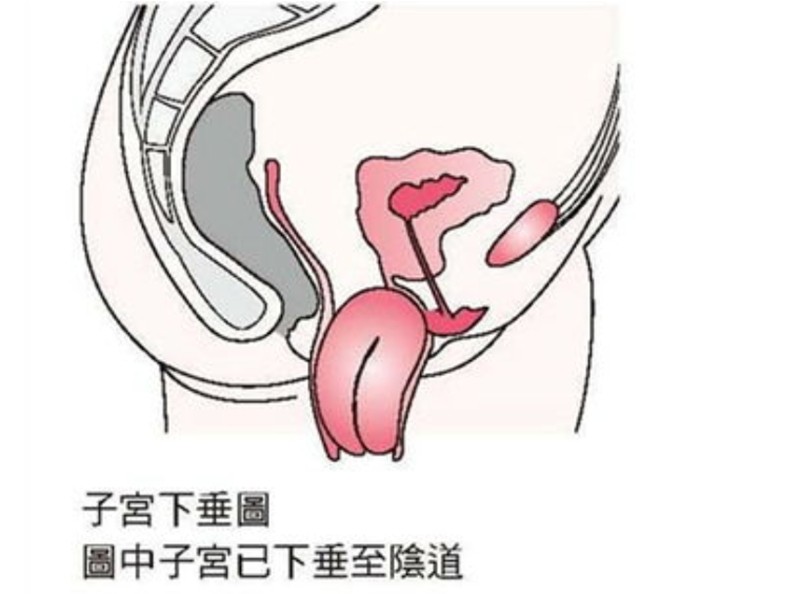 子宮脫垂嚴重化朧