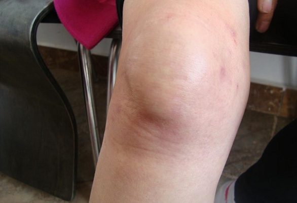 膝蓋骨質增生 (43) 