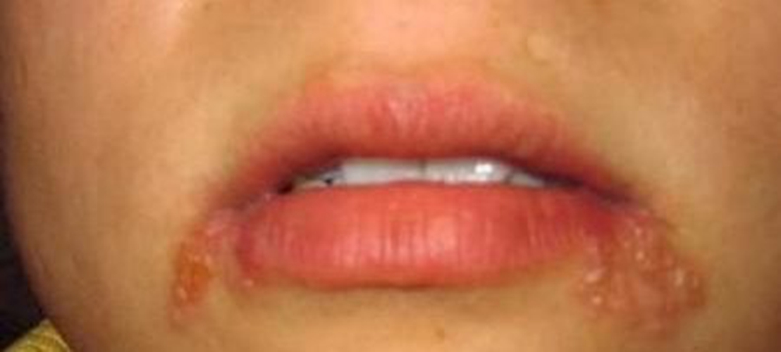 口唇皰疹發炎