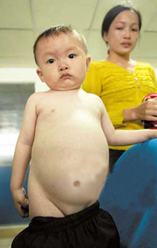 早期肝腹水肚子