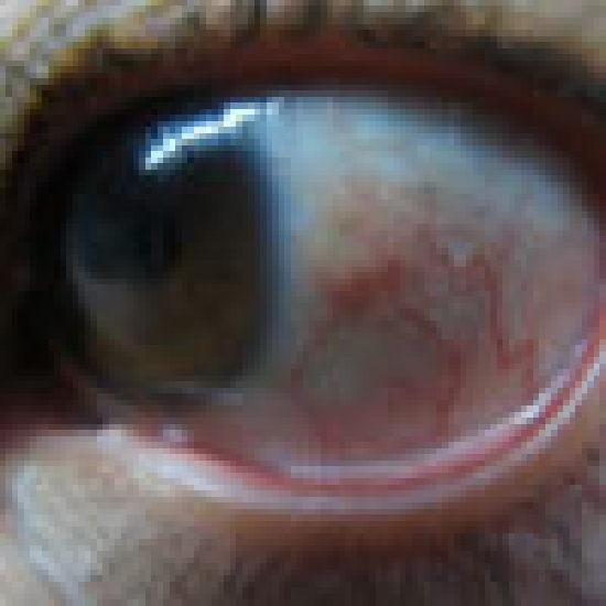 新生血管性的青光眼