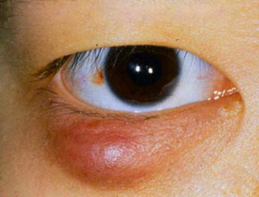 沙眼的症狀