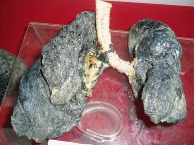 吸菸肺腺癌症狀