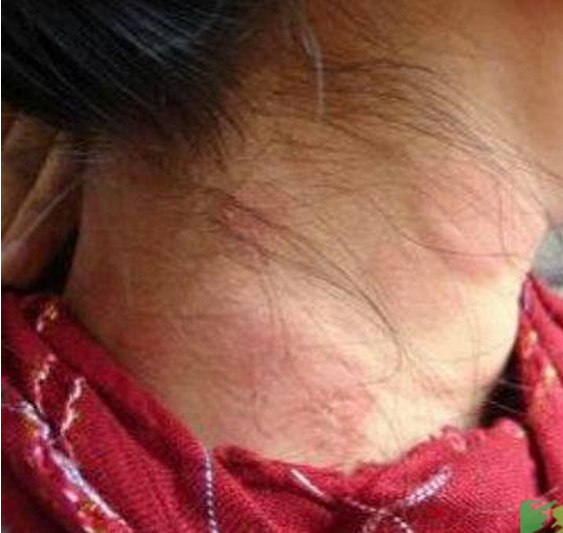 頸部日光性皮炎