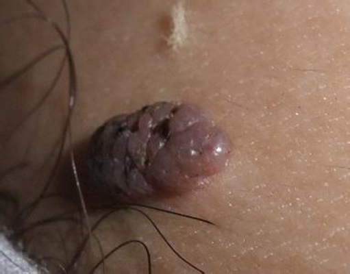 黑痣癌變