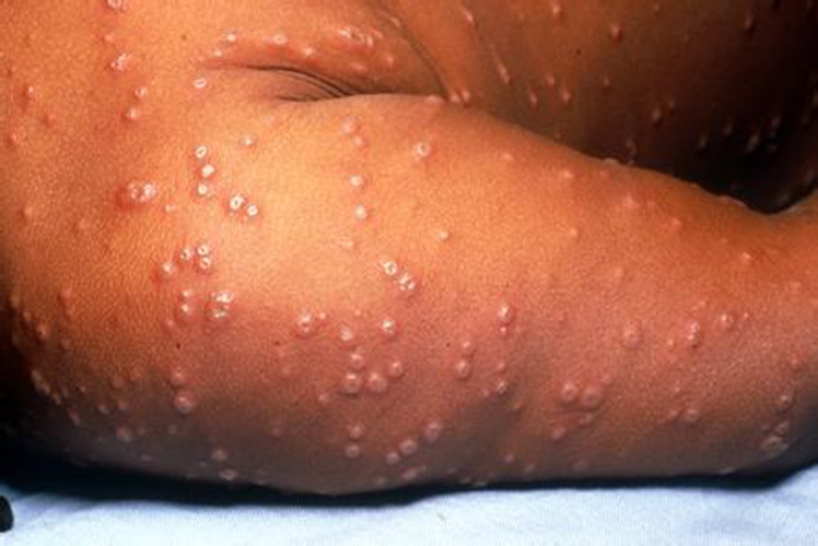 天花與水痘相同嗎