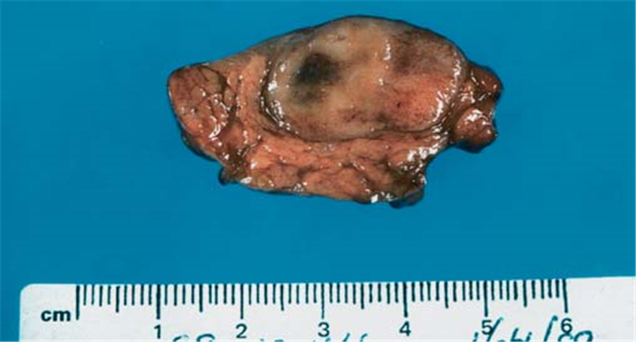 右側腎上腺腫瘤復發切除