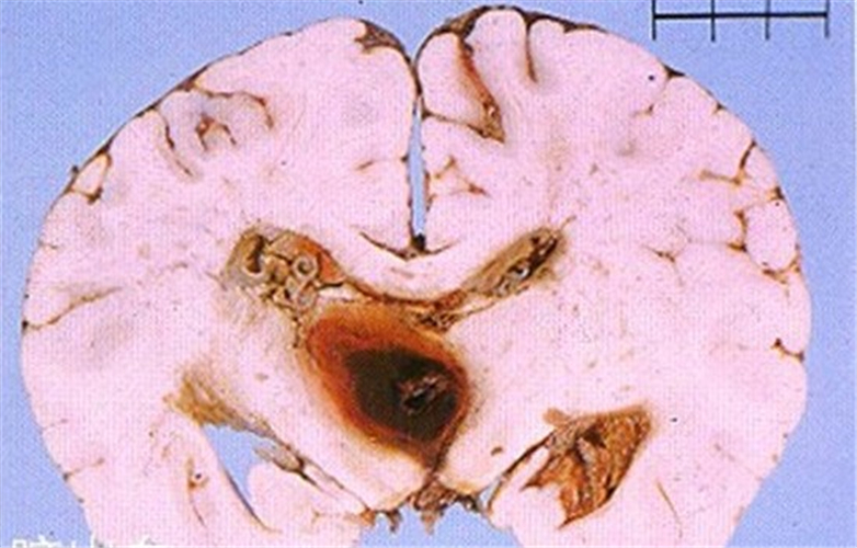 腦血塊導致腦血管痙攣切片