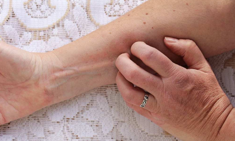 體內有寄生蟲的症狀 (63) 