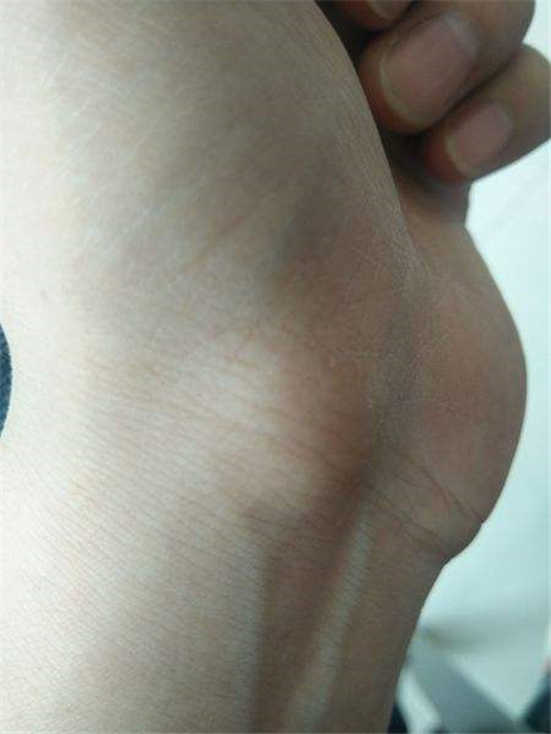 左手手腕處手腕腱鞘炎