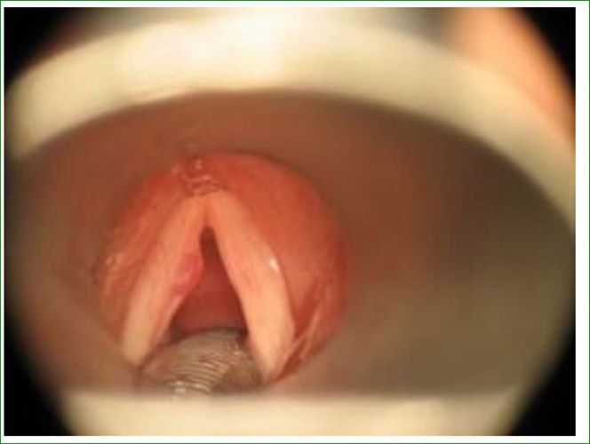 咽喉聲帶息肉的