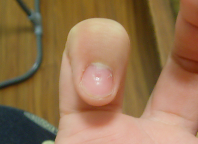 指甲凹陷