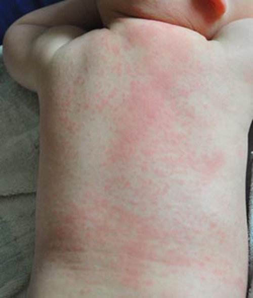 遭遇幼兒急疹背部