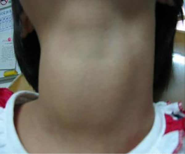 慢性甲狀腺炎症狀