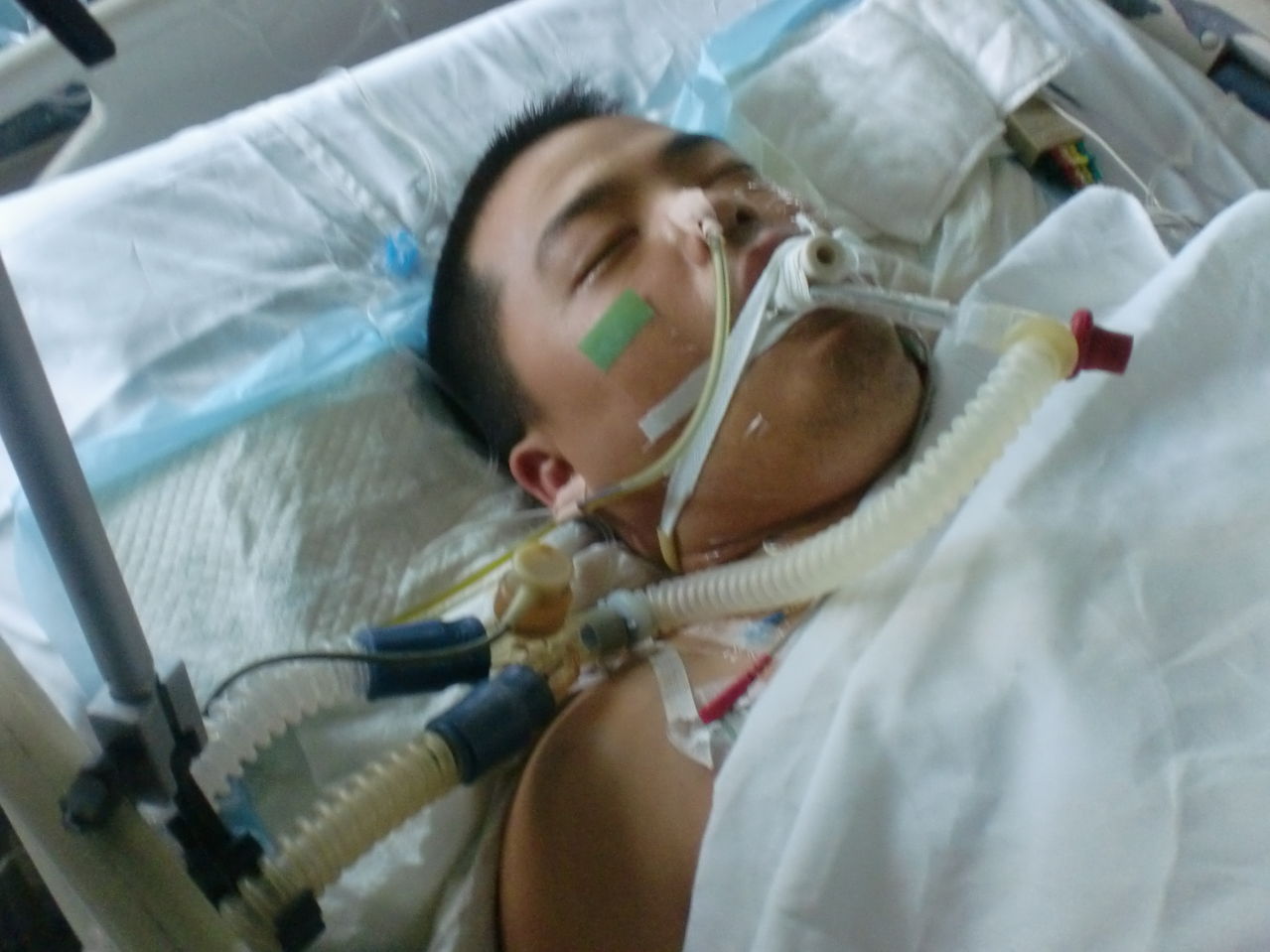 重症急性胰腺炎住院治療