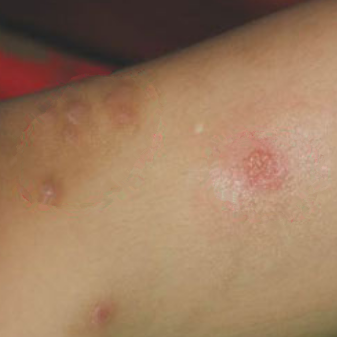 青中年淋巴癌早期症狀的