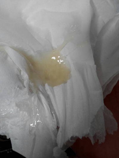 不正常精液液化