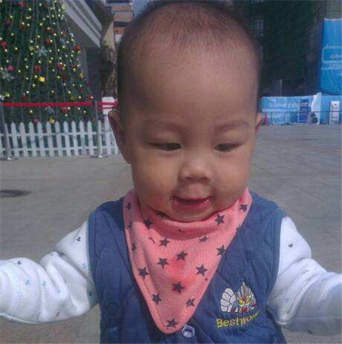 幼兒先天性喉喘鳴