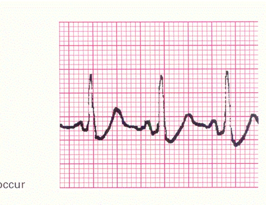 頻發房性早搏 (39) 