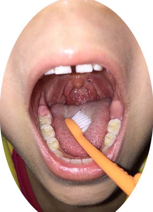 小孩急性咽炎的症狀