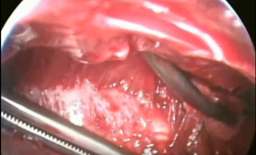 結核性胸膜炎有積液