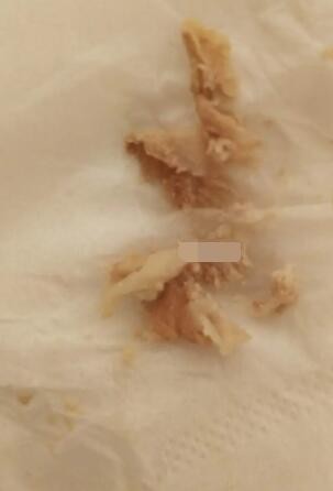 黴菌陰炎症狀 (42) 