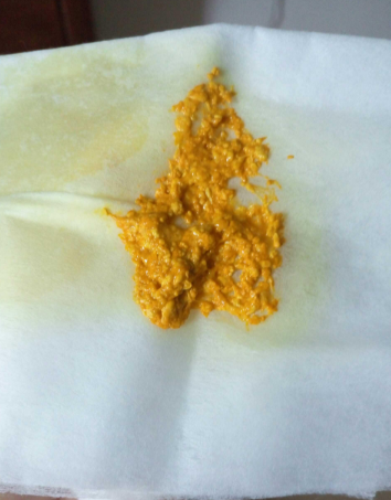 新生兒腹瀉大便