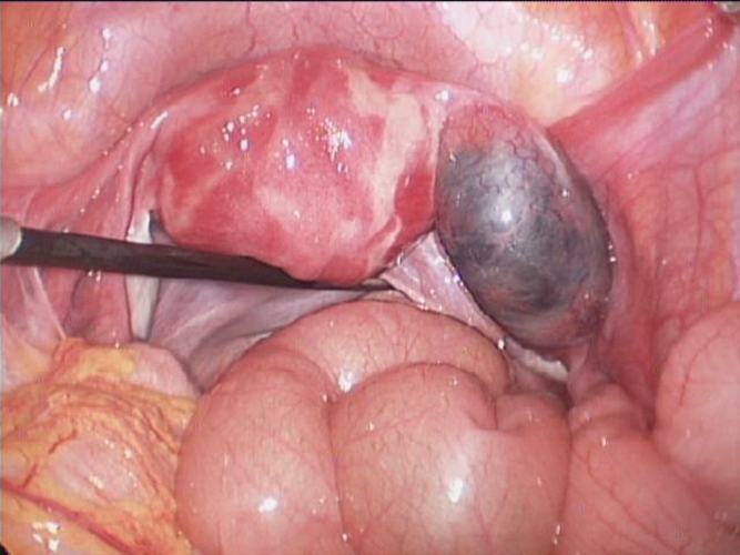 子宮巧克力囊腫