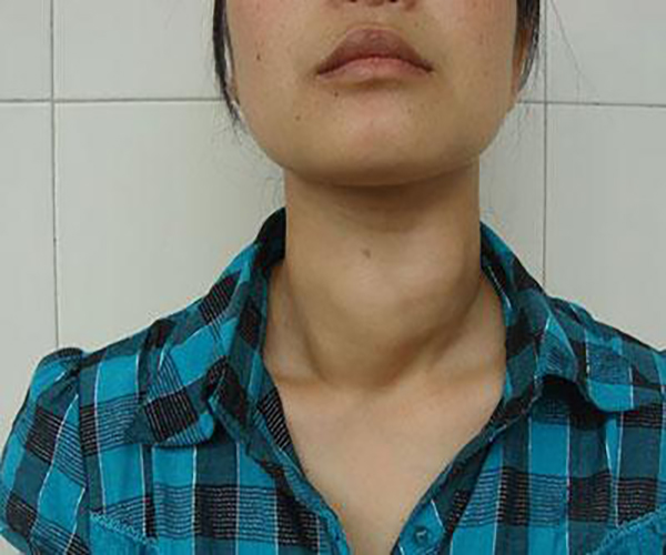 亞急性甲狀腺炎的