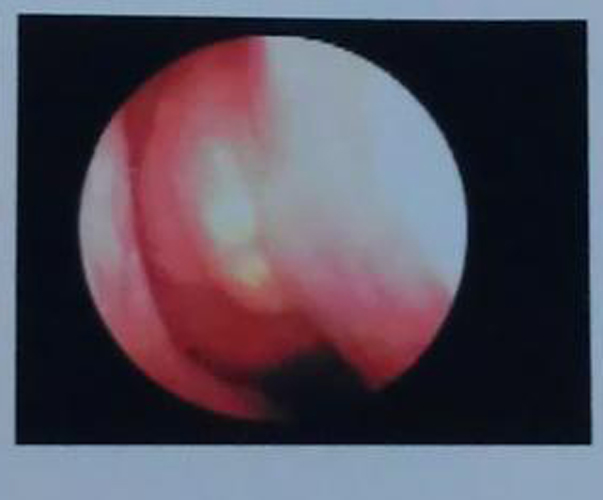 右下甲慢性鼻炎