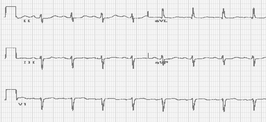 房顫心電圖特點 (65) 