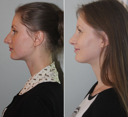 鼻中隔彎曲手術圖解 (46) 