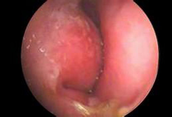 嚴重藥物性慢性鼻炎紅腫