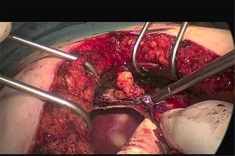 手術治療卵巢癌