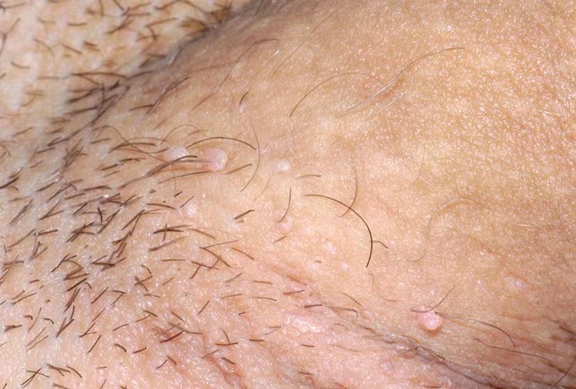 男性尖銳溼疣照片 (43) 