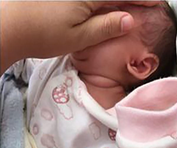 嬰兒甲狀腺腫大的症狀