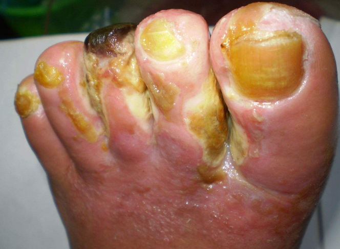 脈管炎早期症狀