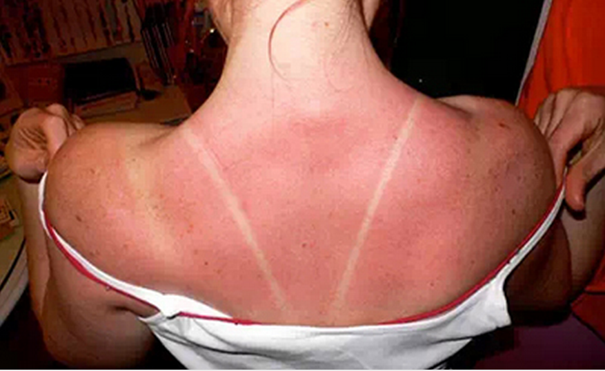 背部日光性皮炎