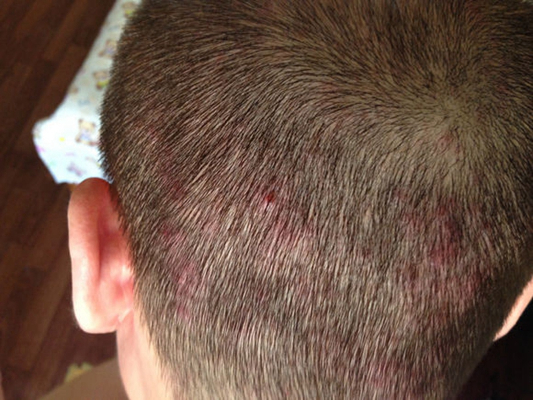 頭皮脂溢性皮炎 (43) 