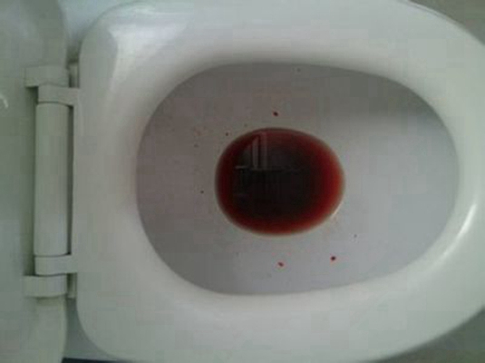 結腸癌症狀 (45) 