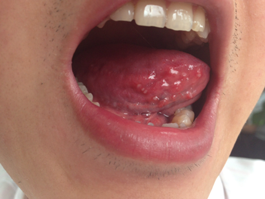 舌癌的初早期症狀