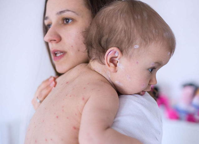 長水痘的症狀 (54) 