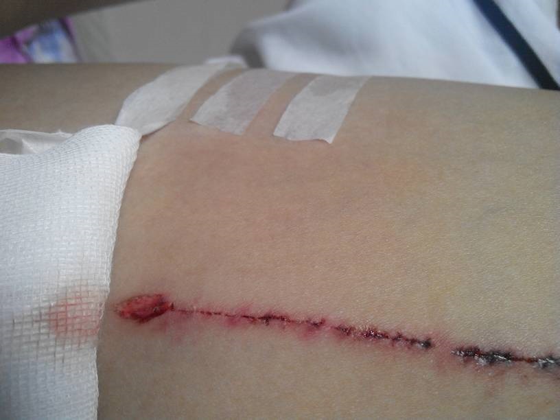 鏽釘子破傷風傷口